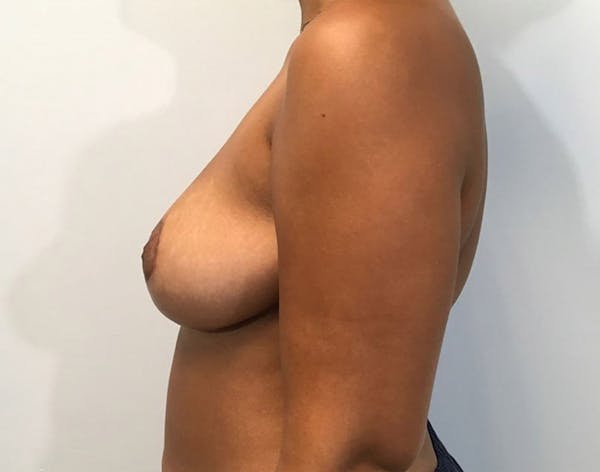 Breast Reduction Before & After Gallery - Patient 4930554 - Image 4