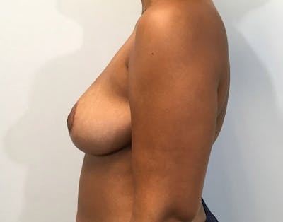Breast Reduction Before & After Gallery - Patient 4930554 - Image 4