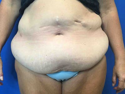 Tummy Tuck (Abdominoplasty) Before & After Gallery - Patient 4931635 - Image 1