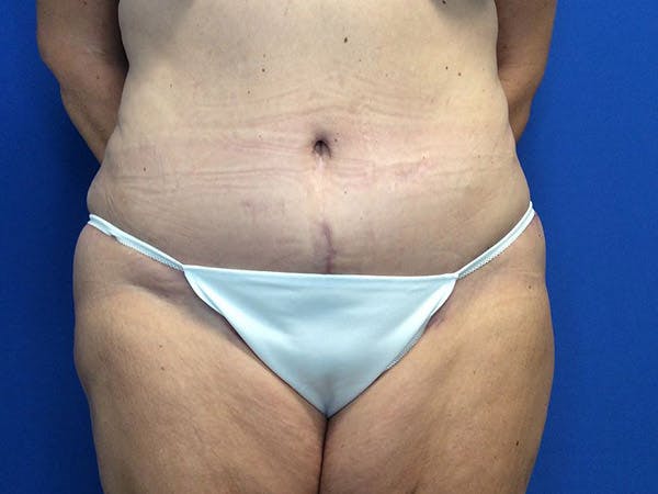 Tummy Tuck (Abdominoplasty) Before & After Gallery - Patient 4931635 - Image 2