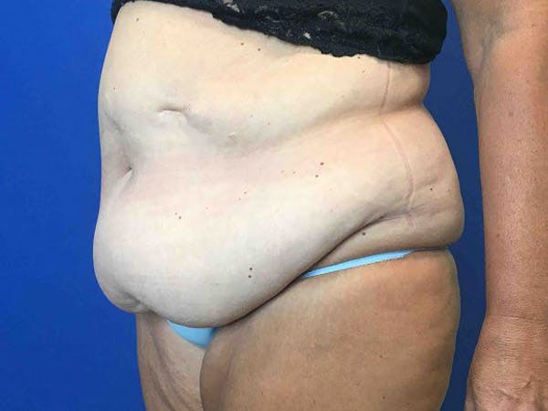 Tummy Tuck (Abdominoplasty) Before & After Gallery - Patient 4931635 - Image 3