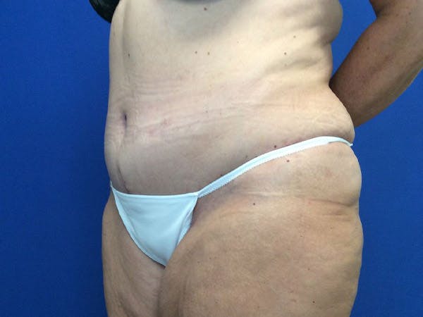 Tummy Tuck (Abdominoplasty) Before & After Gallery - Patient 4931635 - Image 4