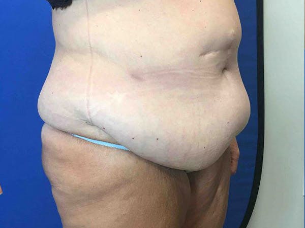 Tummy Tuck (Abdominoplasty) Before & After Gallery - Patient 4931635 - Image 5