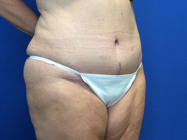 Tummy Tuck (Abdominoplasty) Before & After Gallery - Patient 4931635 - Image 6