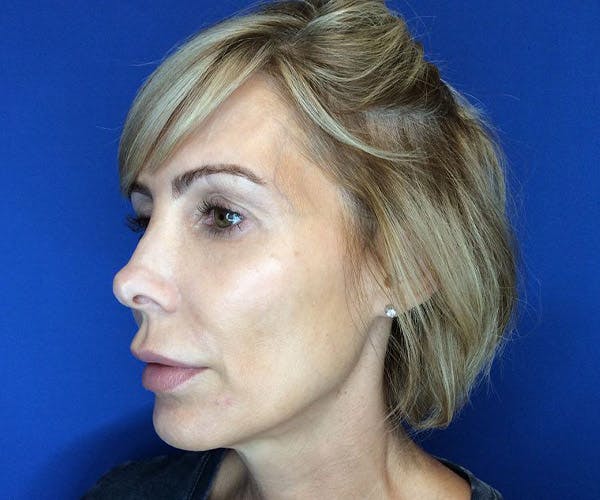 Thread Lift Before & After Gallery - Patient 4933193 - Image 3