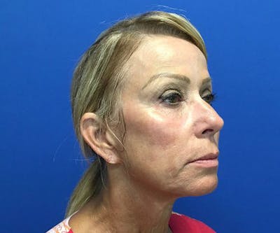 Thread Lift Before & After Gallery - Patient 4933192 - Image 1