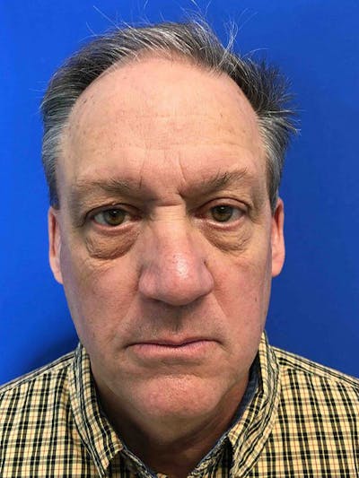 Blepharoplasty Before & After Gallery - Patient 5040065 - Image 1