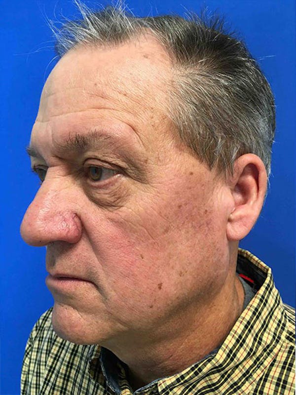 Blepharoplasty Before & After Gallery - Patient 5040065 - Image 3