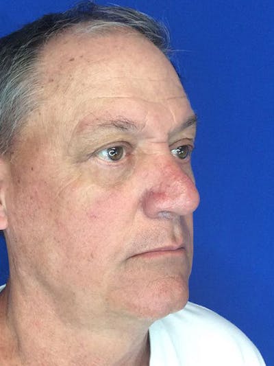 Blepharoplasty Before & After Gallery - Patient 5040065 - Image 6