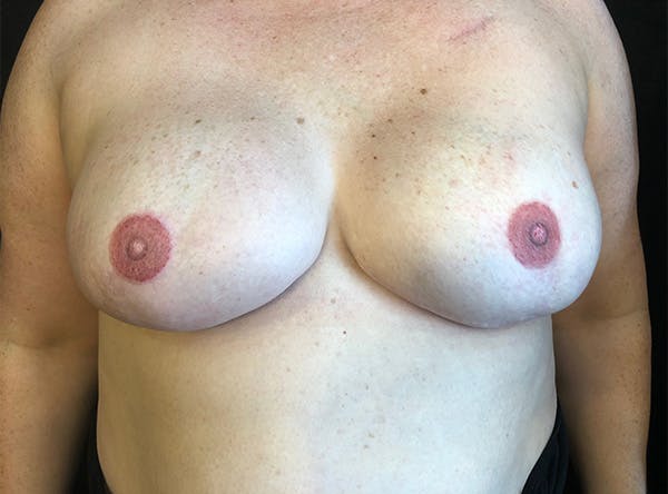Breast Implant Reconstruction Before & After Gallery - Patient 5063356 - Image 2
