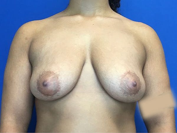 Breast Augmentation Before & After Gallery - Patient 5069143 - Image 1