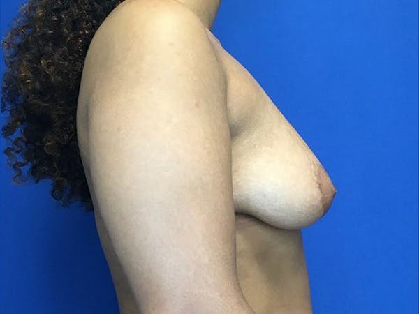 Breast Augmentation Before & After Gallery - Patient 5069143 - Image 5