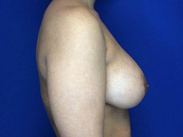 Breast Augmentation Before & After Gallery - Patient 5069143 - Image 6