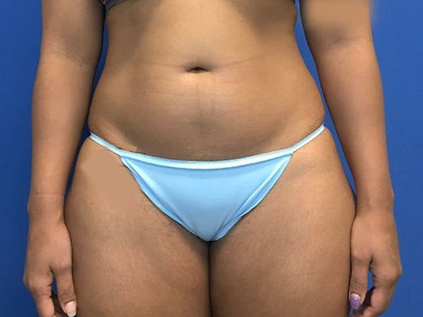 Liposuction Before & After Gallery - Patient 5069175 - Image 1