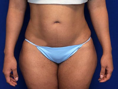 Liposuction Before & After Gallery - Patient 5069175 - Image 2