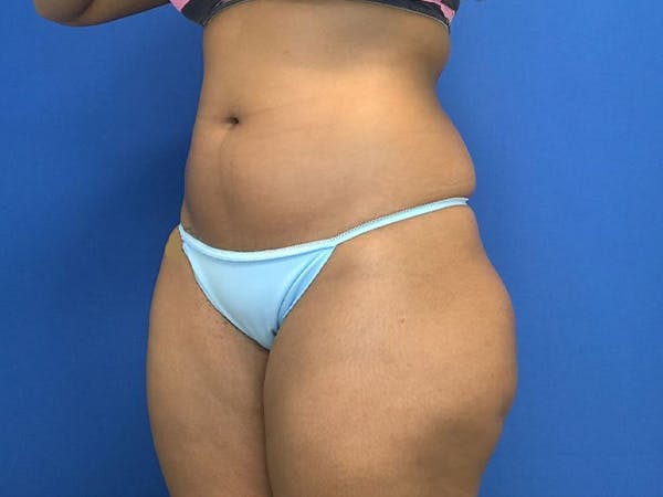Liposuction Gallery - Patient 5069175 - Image 3