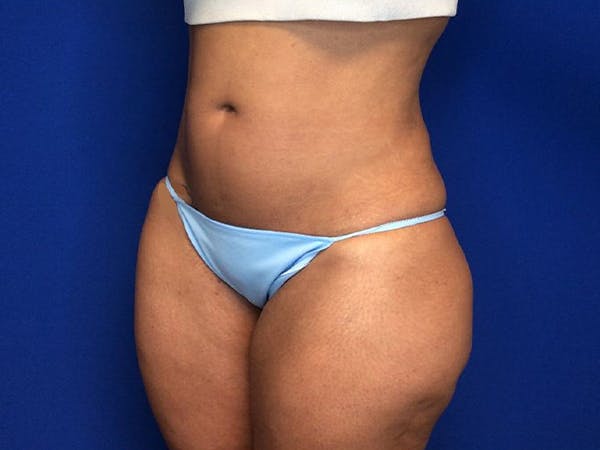 Liposuction Before & After Gallery - Patient 5069175 - Image 4