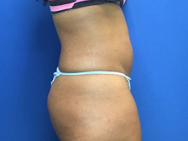 Liposuction Before & After Gallery - Patient 5069175 - Image 5