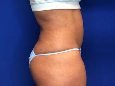 Liposuction Before & After Gallery - Patient 5069175 - Image 6