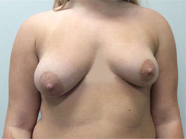 Mastopexy Before & After Gallery - Patient 5092295 - Image 1