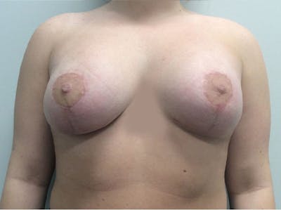 Mastopexy Before & After Gallery - Patient 5092295 - Image 2