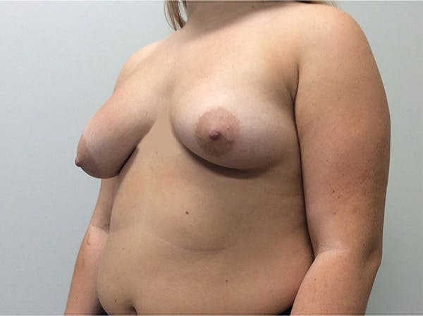 Mastopexy Before & After Gallery - Patient 5092295 - Image 3