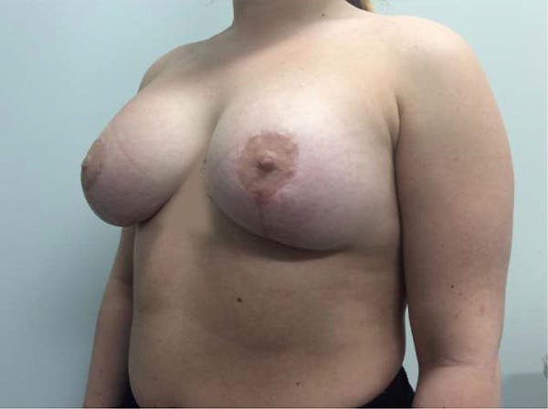 Mastopexy Before & After Gallery - Patient 5092295 - Image 4