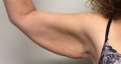 Arm Lift Before & After Gallery - Patient 5113285 - Image 1