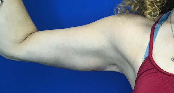 Arm Lift Before & After Gallery - Patient 5113285 - Image 2