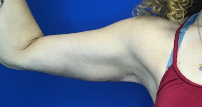 Arm Lift Before & After Gallery - Patient 5113285 - Image 2