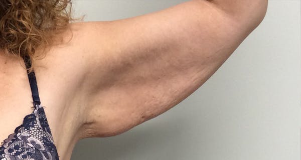 Arm Lift Before & After Gallery - Patient 5113285 - Image 3