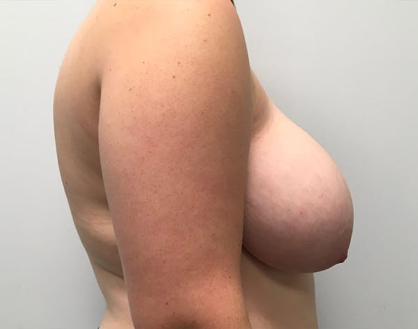 Breast Reduction Before & After Gallery - Patient 5147865 - Image 3