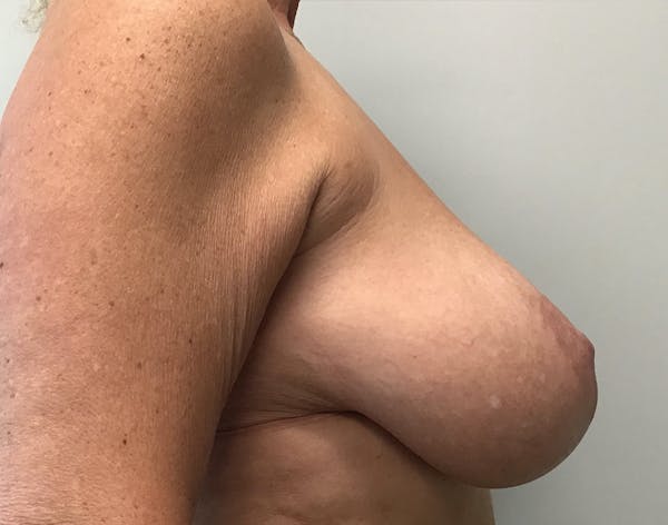 Breast Reduction Before & After Gallery - Patient 5724810 - Image 3