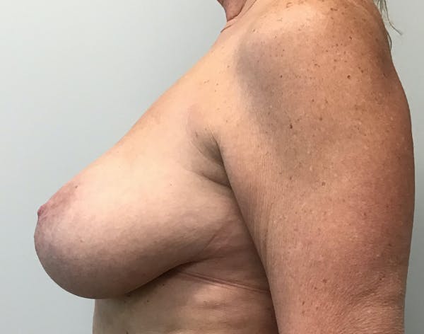 Breast Reduction Before & After Gallery - Patient 5724810 - Image 5