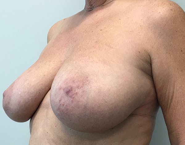 Breast Reduction Before & After Gallery - Patient 5724810 - Image 9