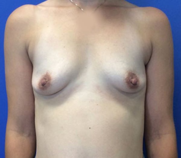Breast Augmentation Before & After Gallery - Patient 4594829 - Image 1