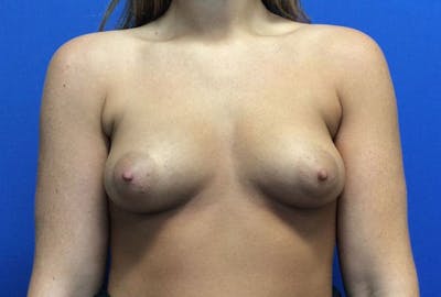 Breast Augmentation Before & After Gallery - Patient 4594837 - Image 1