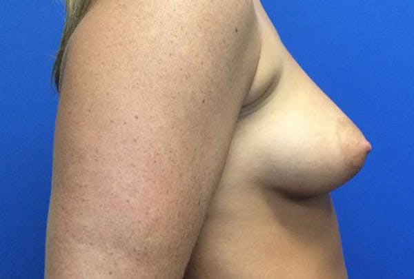 Breast Augmentation Before & After Gallery - Patient 4594837 - Image 5