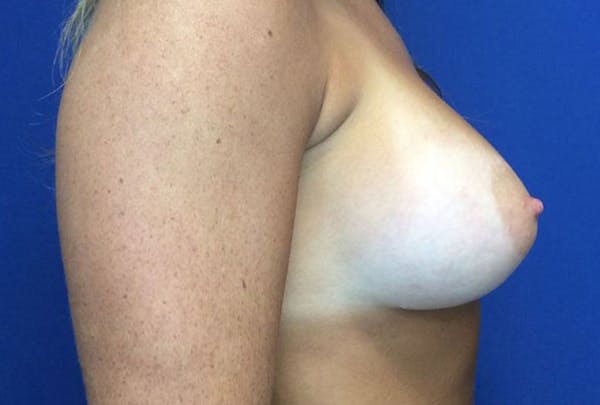 Breast Augmentation Before & After Gallery - Patient 4594837 - Image 6