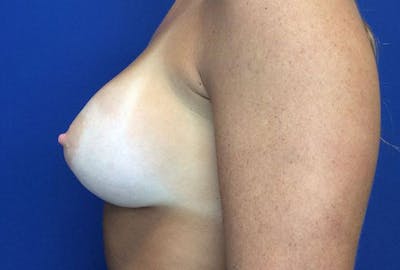 Breast Augmentation Before & After Gallery - Patient 4594837 - Image 10