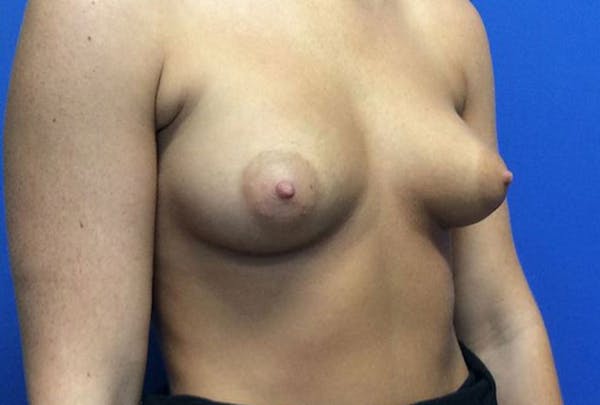 Breast Augmentation Before & After Gallery - Patient 4594837 - Image 7