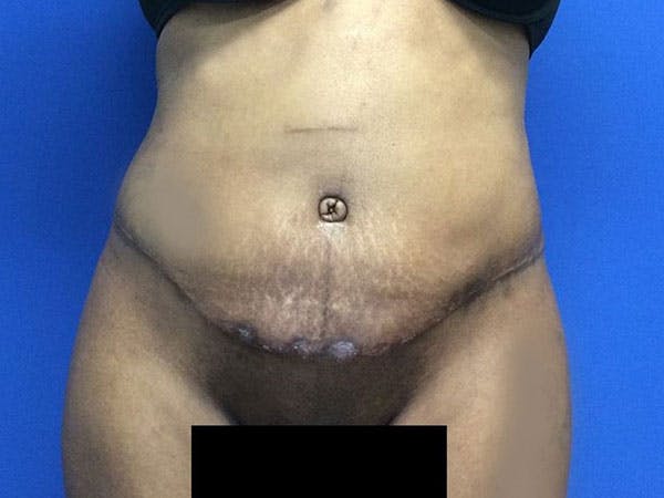 Tummy Tuck (Abdominoplasty) Before & After Gallery - Patient 6280095 - Image 2