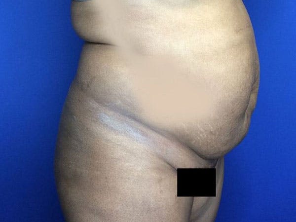 Tummy Tuck (Abdominoplasty) Gallery - Patient 6280095 - Image 3