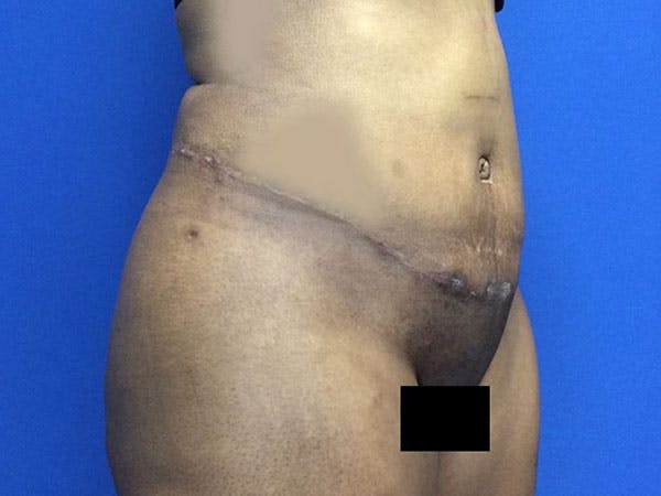 Liposuction Before & After Gallery - Patient 6280112 - Image 4
