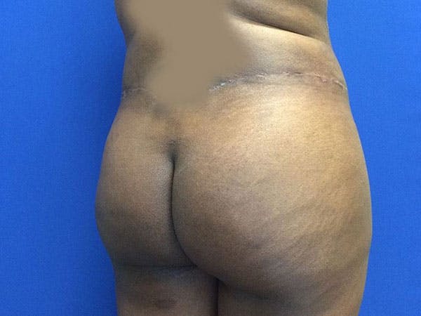 Liposuction Before & After Gallery - Patient 6280112 - Image 6