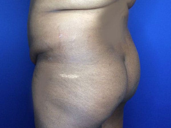 Tummy Tuck (Abdominoplasty) Before & After Gallery - Patient 6280095 - Image 7