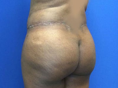 Liposuction Before & After Gallery - Patient 6280112 - Image 8