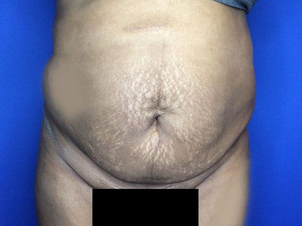 Liposuction Before & After Gallery - Patient 6280112 - Image 1