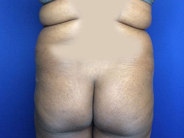 Tummy Tuck (Abdominoplasty) Before & After Gallery - Patient 6280095 - Image 9