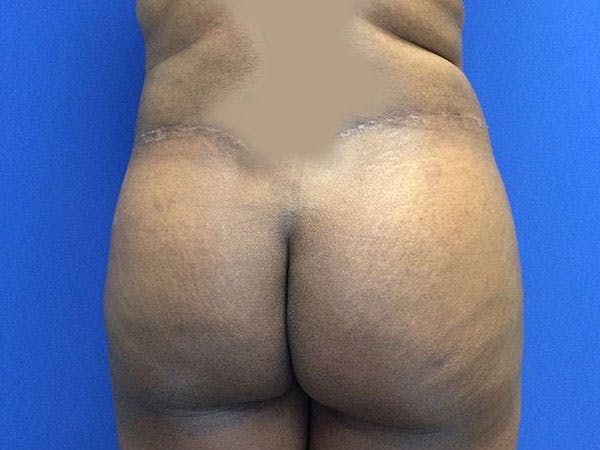 Tummy Tuck (Abdominoplasty) Gallery - Patient 6280095 - Image 10